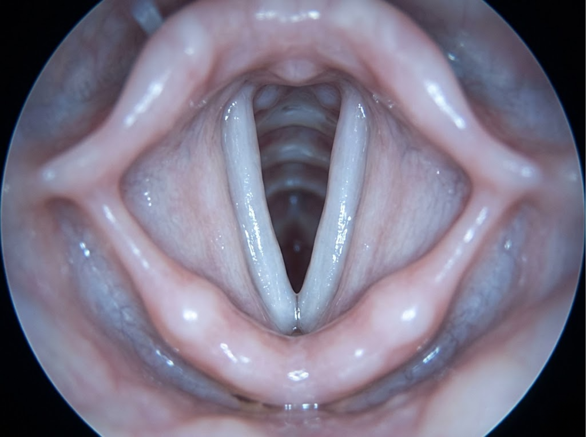 Laryngoscope view of healthy, smooth vocal cords after 8 weeks of proper elevation — After