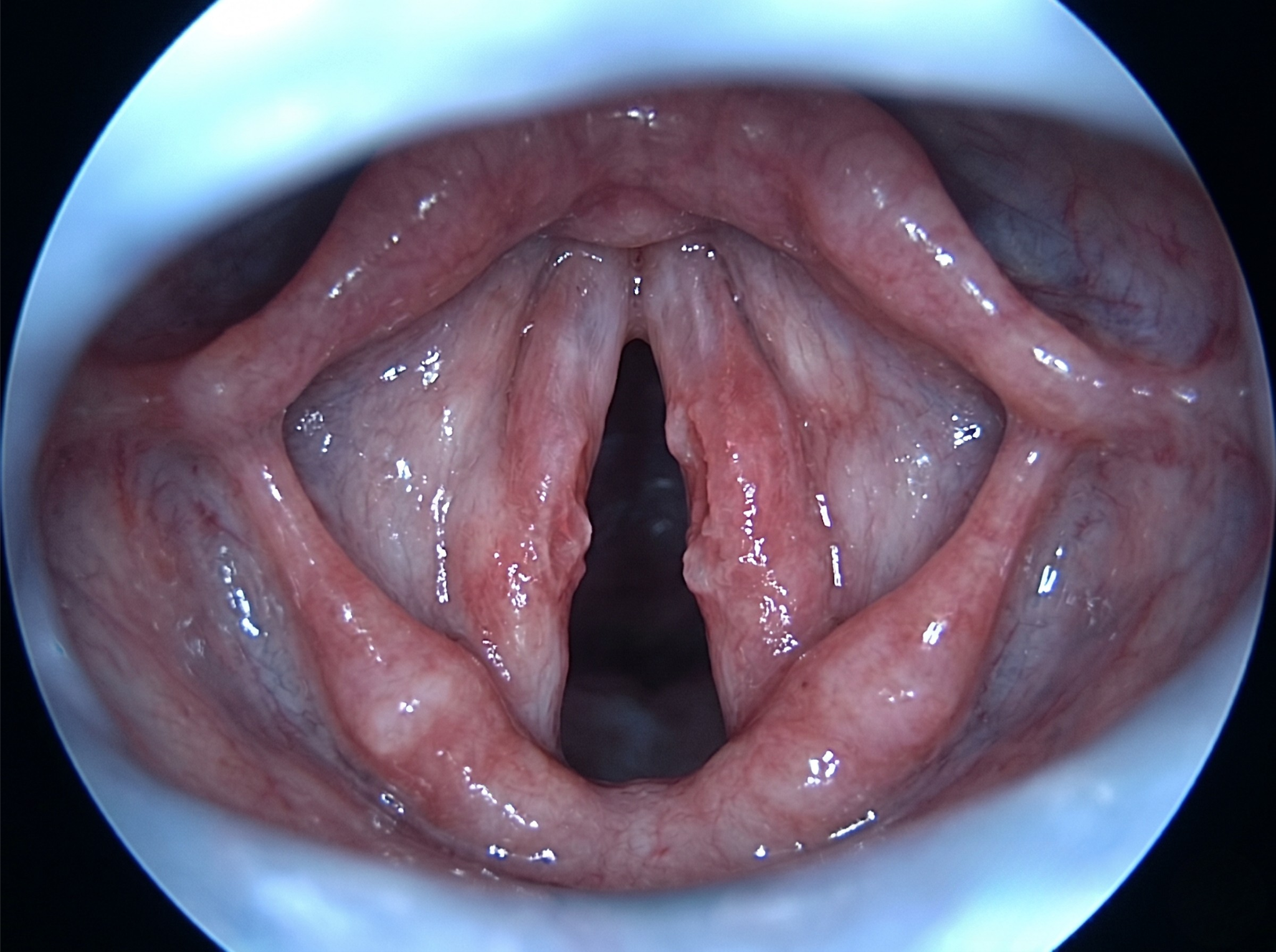 Laryngoscope view of inflamed, reddened vocal cords caused by acid reflux — Before